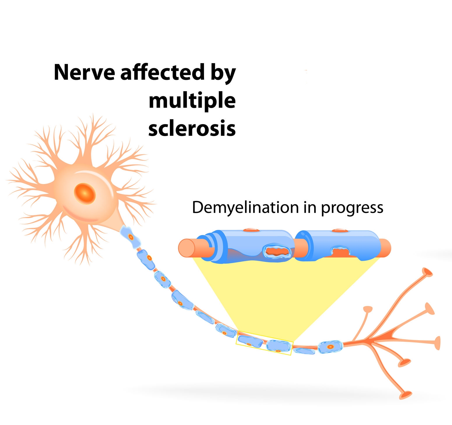 Nerve damaged by multiple sclerosis