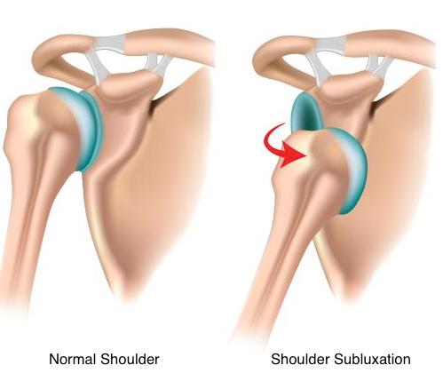 The Best Treatment for Shoulder Subluxation