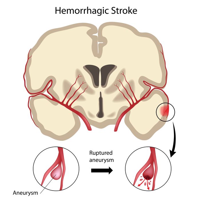 image of hemorrhagic stroke