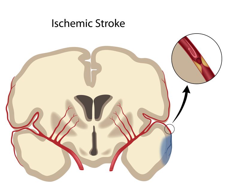 image of ischemic stroke