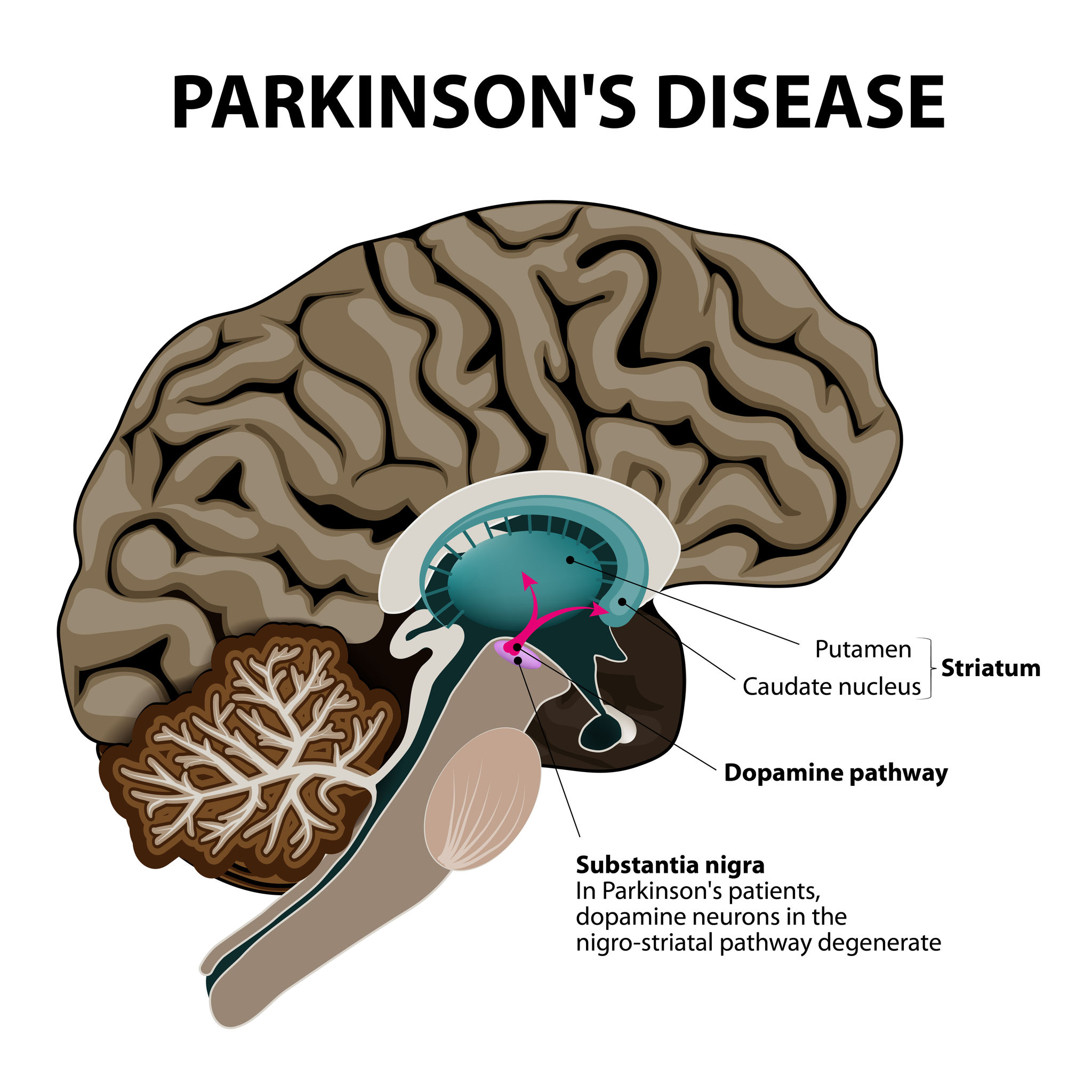 Image of a brain with parkinsons disease