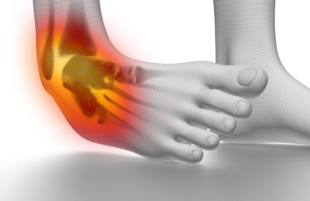 vector image of a spastic ankle