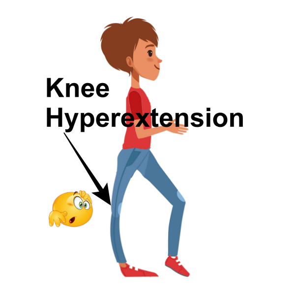 vector image of knee hyperextension