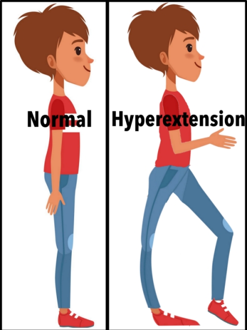 Knee Hyperextension after a Stroke: Causes and Treatment