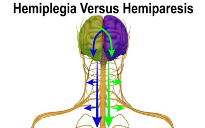 Hemiplegia Versus Hemiparesis