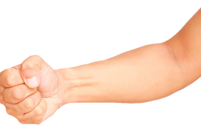 What Causes a Clenched Hand After a Stroke