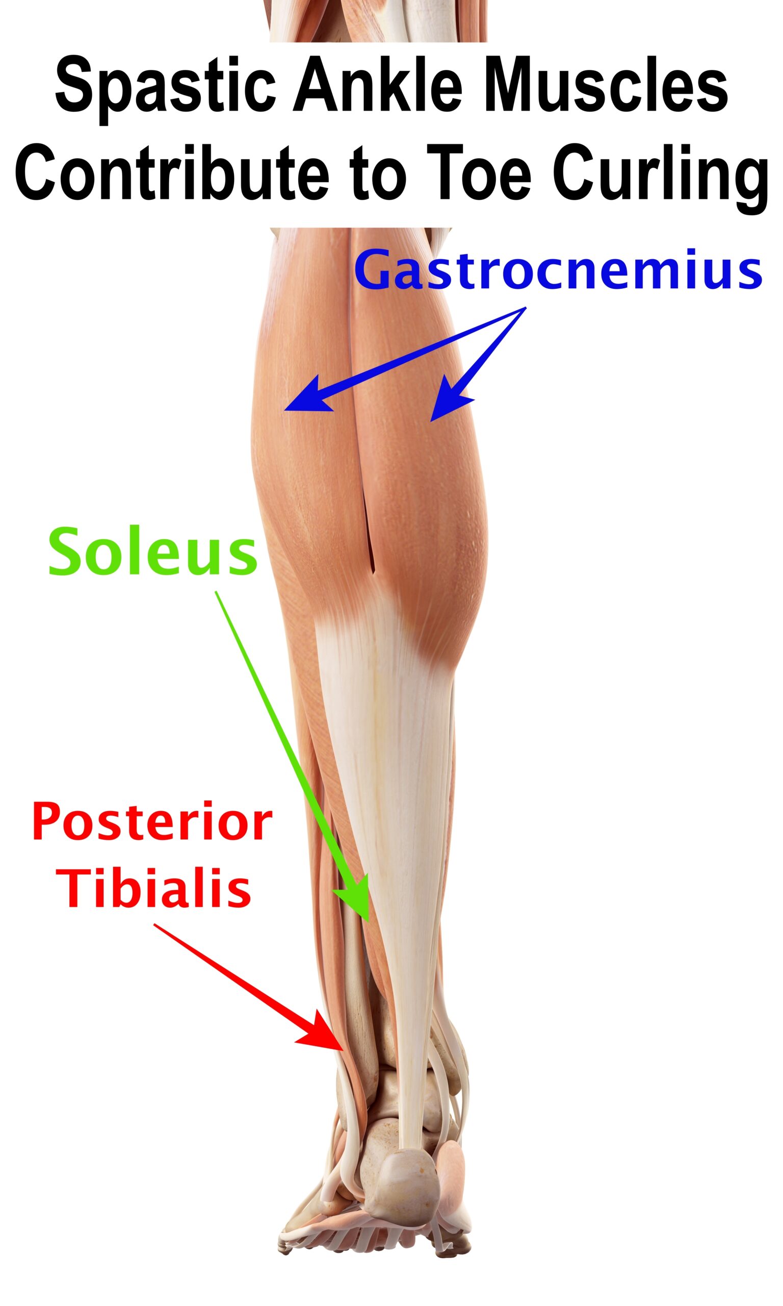 vector image of spastic ankle muscles that contribute to toe curling
