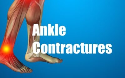 Ankle Contractures: Best and worst treatments