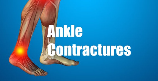 ankle contractures