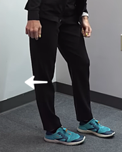Image showing Tara's lower body , demonstrating knee hyperextension in standing. The affected knee is locked backward, creating an excessive curve in the leg alignment.