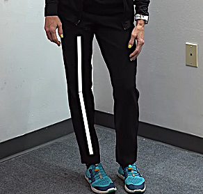 Image of Tara Tobias, waist down, demonstrating a hyperextended knee with the leg straightened backward beyond its normal alignment.