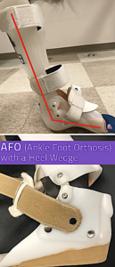 AFO and heel wedge images